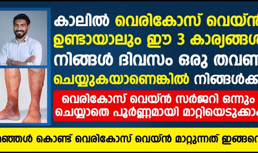 വെരിക്കോസ് വെയിൻ  ഉണ്ടാകാനുള്ള  കാരണങ്ങളും പരിഹാരമാർഗങ്ങളും.