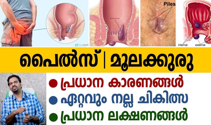 മൂലക്കുരു പൈൽസ് തുടങ്ങിയവയുടെ  കാരണങ്ങൾ അറിഞ്ഞുവേണം ചികിത്സിക്കാൻ