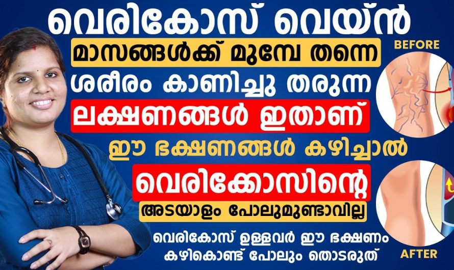 വെരിക്കോസ് വെയിൻ എങ്ങനെ പ്രതിരോധിക്കാം  .