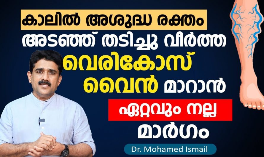 നിങ്ങൾ വെരിക്കോസ് വെയിൻ ബുദ്ധിമുട്ട് അനുഭവിക്കുന്ന ആളാണോ എങ്കിൽ ഈ വീഡിയോ ഒന്ന് കണ്ടു നോക്കൂ.