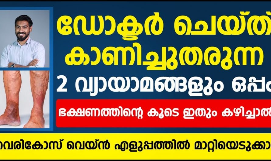 വെരിക്കോസ് വെയിൻ രോഗികൾ ശ്രദ്ധിക്കേണ്ടത്…