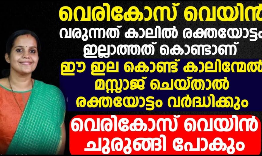 വെരിക്കോസ് പരിഹരിക്കാൻ ഇത്തരം കാര്യങ്ങൾ പ്രത്യേകം ശ്രദ്ധിക്കുക..