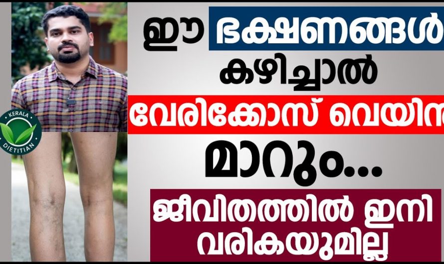 വെരിക്കോസ് വെയിൻ ഇത്തരം കാര്യങ്ങൾ നിർബന്ധമായും ശ്രദ്ധിക്കുക.