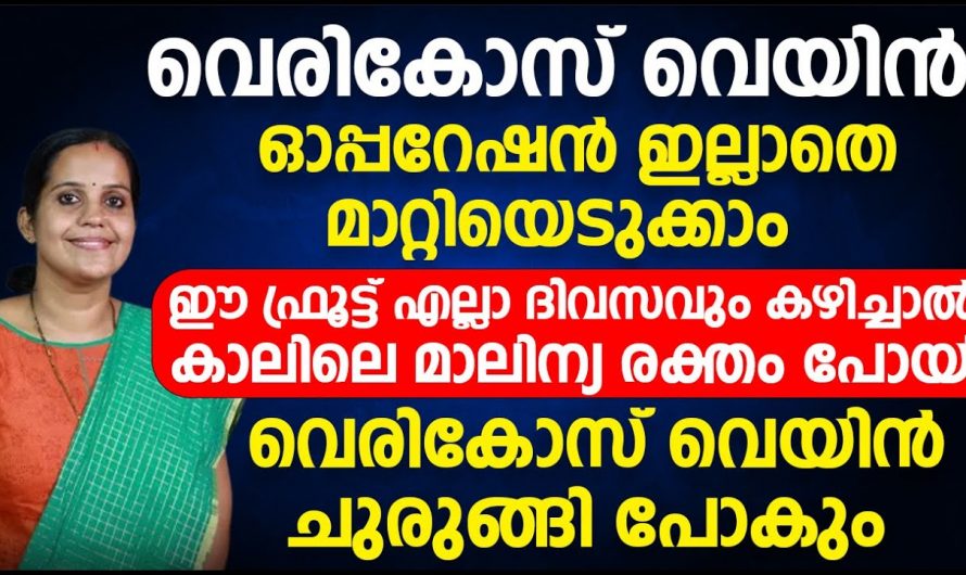 എങ്ങനെ ഓപ്പറേഷൻ ഇല്ലാതെ വേരിക്കോസ് വെയിൻ മാറ്റിയെടുക്കാം