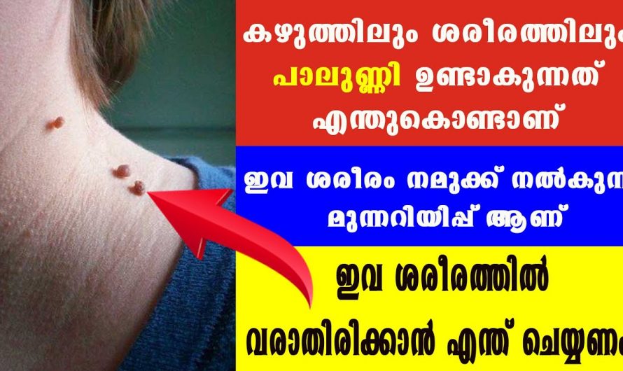 പാലുണ്ണിയും  അരിമ്പാറയും  എളുപ്പത്തിൽ പരിഹരിക്കാൻ.