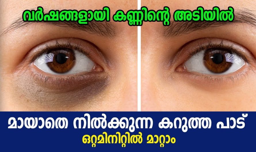 കണ്ണിനു ചുറ്റുമുള്ള കറുപ്പ് നിറം നീക്കം ചെയ്ത് മുഖസൗന്ദര്യം നിലനിർത്താൻ…👌