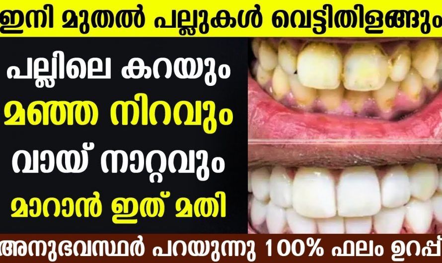 പല്ലുകളിലെ മഞ്ഞനിറവും കറയും പരിഹരിച്ച് പല്ലുകളെ സംരക്ഷിക്കാൻ..