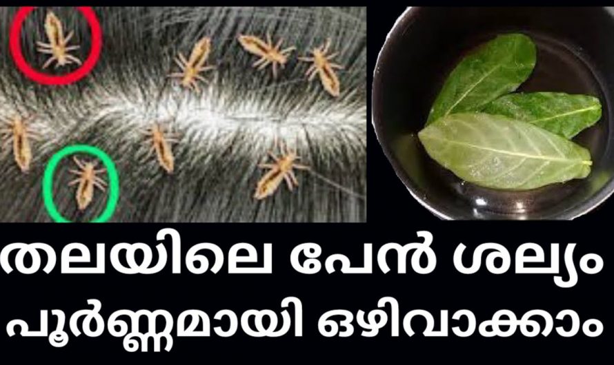 തലമുടിയിലെ താരനും പേന്‍ ശല്യവും എളുപ്പത്തിൽ ഒഴിവാക്കാൻ.