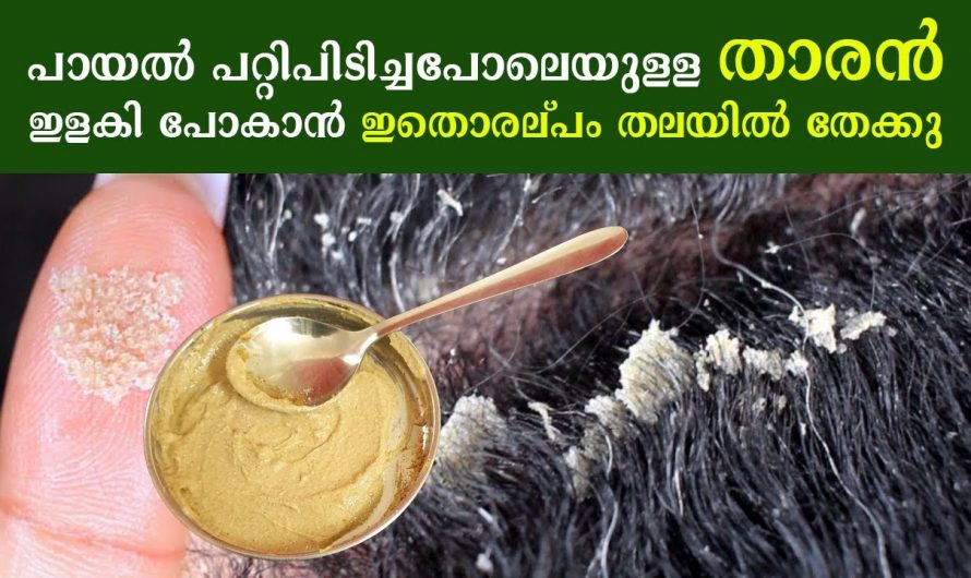 തലമുടിയിൽ താരൻ പരിഹരിച്ച് മുടിയെ സംരക്ഷിക്കാൻ കിടിലൻ മാർഗ്ഗം…