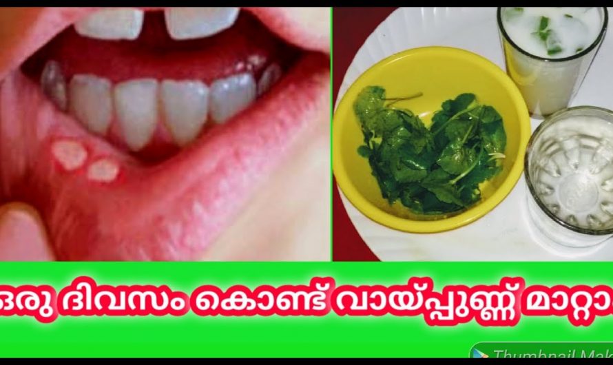 സ്ഥിരമായി ഉണ്ടാകുന്ന വായ്പുണ്ണ് എളുപ്പത്തിൽ പരിഹരിക്കാം…