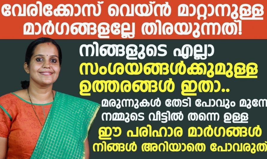 വെരിക്കോസ് വെയിന്റെ കാരണങ്ങളും പരിഹാരമാർഗങ്ങളും..