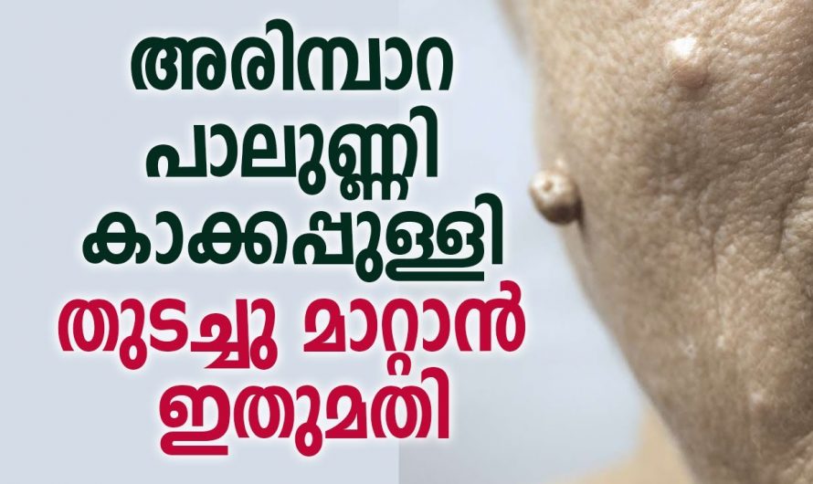 കർമ്മത്തിൽ അഭംഗി സൃഷ്ടിക്കുന്ന അരിമ്പാറയും പാലുണ്ണിയും എളുപ്പത്തിൽ നീക്കം ചെയ്യാം.