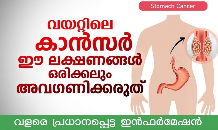 വയറിലുണ്ടാകുന്ന ക്യാൻസറിന്റെ പ്രധാനപ്പെട്ട ലക്ഷണങ്ങൾ.