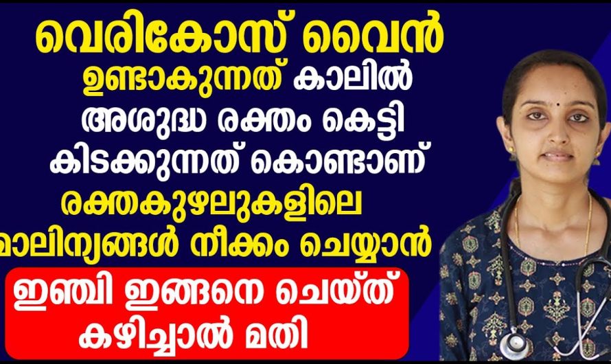 വെരിക്കോസ് വെയിൻ ഉണ്ടാകുന്നതിന്റെ കാരണങ്ങളും ലക്ഷണങ്ങളും.👌