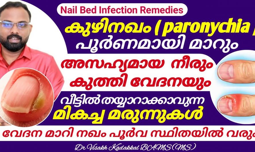 കുഴിനഖം പരിഹരിച്ച് നഖങ്ങളുടെ ഭംഗി നിലനിർത്താൻ…👌