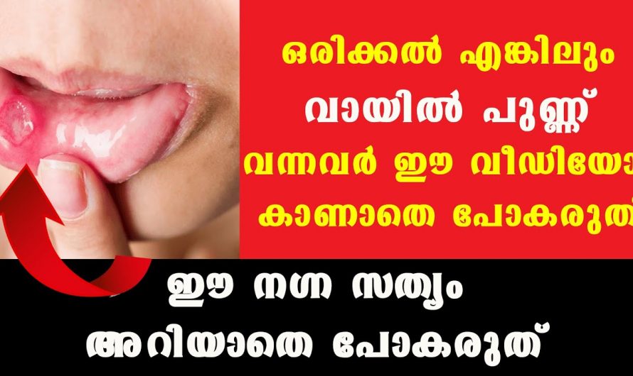 വായ്പുണ്ണ് അഥവാ മൗത്ത് അൾസർ എളുപ്പത്തിൽ പരിഹരിക്കാൻ..😱