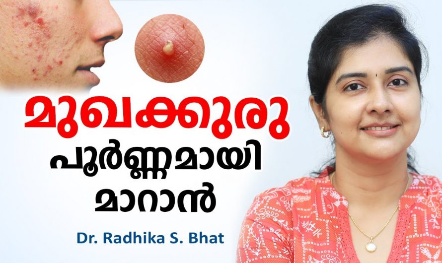 മുഖക്കുരു  എന്ന ഈ പ്രശ്നം പൂർണമായി മാറുവാൻ ഇങ്ങനെ ചെയ്താൽ മതി🥰